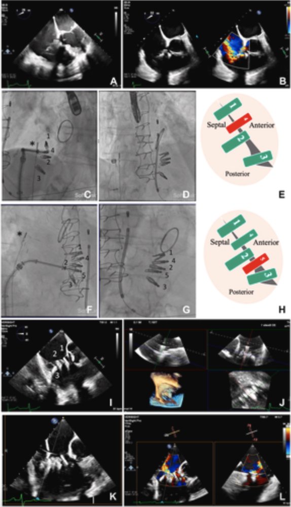 Hot off press 'Fundamental Roles of ICE & Fluoroscopy in Redo Tricuspid Transcatheter Edge-to-Edge Repair Procedure' published in JACC Interventions @GilbertTangMD @ParasuramMD Link → bit.ly/3V5ft5b