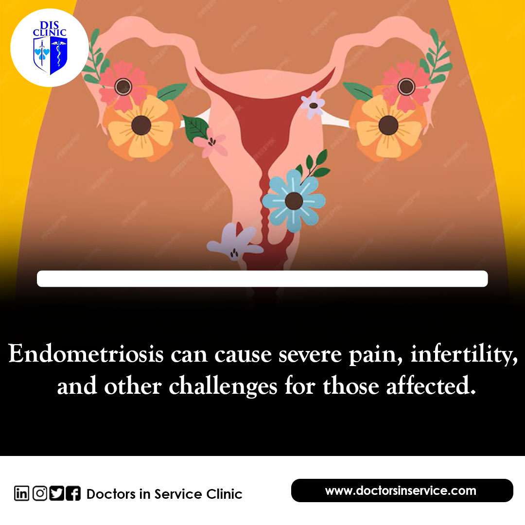 Endometriosis is a condition where tissue like the womb lining grows elsewhere in the body. The exact cause is unknown, but some possible factors are genetics, immune system, hormones, and retrograde menstruation. #disclinic #EndometriosisAwareness