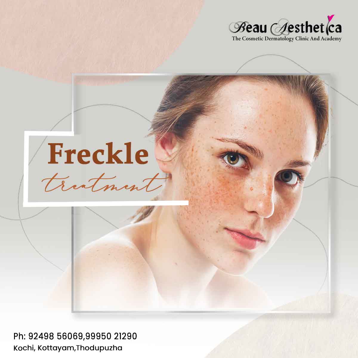 Book your consultation today and take the first step towards freckle-free perfection. ✨ Topical Treatments ✨ Laser Therapy ✨ Chemical Peels For appointment: 92498 56069 / 99950 21290 #FreckleFree #CosmeticTreatments #freckles #freckletreatment #facecaretreatment