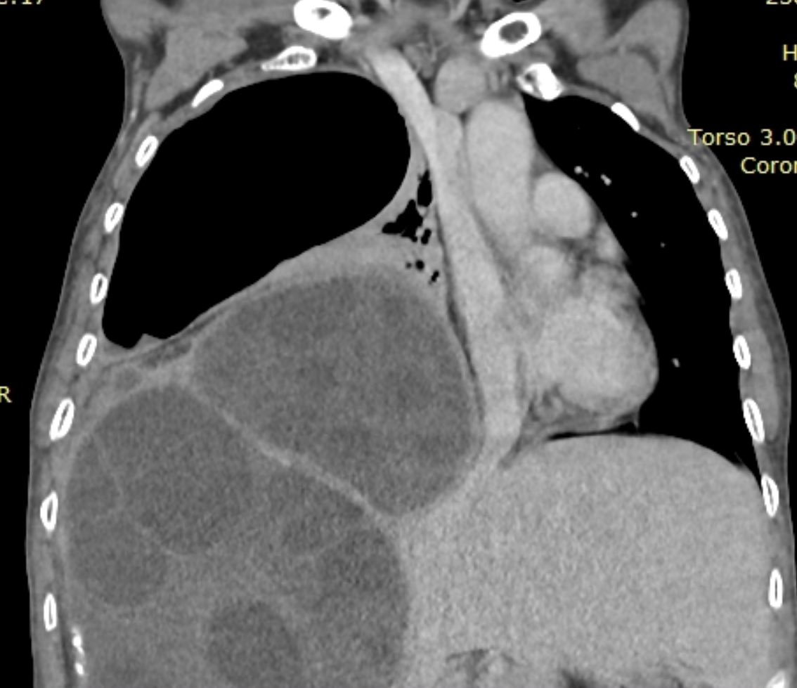 PAUSEHNDM2023's tweet image. Mujer 56a , proviene de Los Andes del Perú. Acude por dolor en hipocondrio derecho y disnea desde hace 2 meses . Se sospecha de Quiste Hidatidico a nivel Pulmonar y Hepático por Ecografía . Luego se verifica con TAC #QUISTES #POCUSFIRST @ondasPOCUS @DreyfussAndrea @AngelFarro1