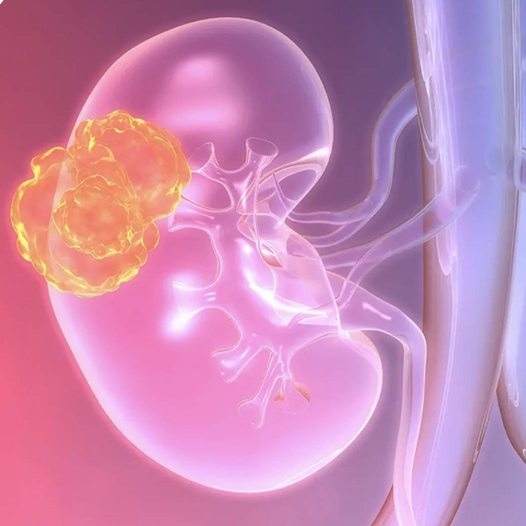 Recent advances in #nuclearmedicine have expanded to include the diagnosis of #KidneyCancer. This morning, we offered the first patients in Italy the chance to receive a more accurate diagnosis of their renal masses with 89Zr-DFO-girentuximab @SanRaffaeleMI @MyUniSR.
