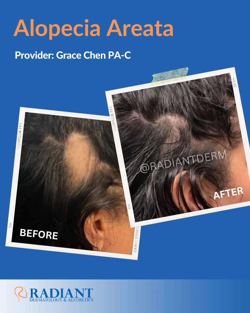 Radiantdermtx's tweet photo. Transform alopecia areata challenges into success with Grace Chen PA-C. ILK injections offer hope for hair regrowth. Book now: 📞281-973-4159 📧info@radiantdermtx.com 🌐https://t.co/BiUu9se7q9 #alopeciaareata #AlopeciaCare #GraceChenPA-C #hairloss #hairregrowth #ilkinjections https://t.co/XqvzZYqTRD