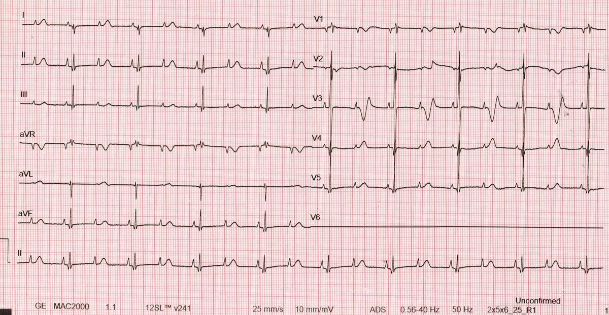 An unruly case of functional two-to-one atrioventricular block... @SerhatKocadr @haziktabip @Mkara_EP @ElifhandeMD @DuyguKocyigitMD @IMerovci @AhmetKorkmaz07A @drfiratozcan @prof_serkan_cay @ozcanozeke @DursunAras2 @topaloglu_prof doi.org/10.1016/j.hrth… @hrs_journal