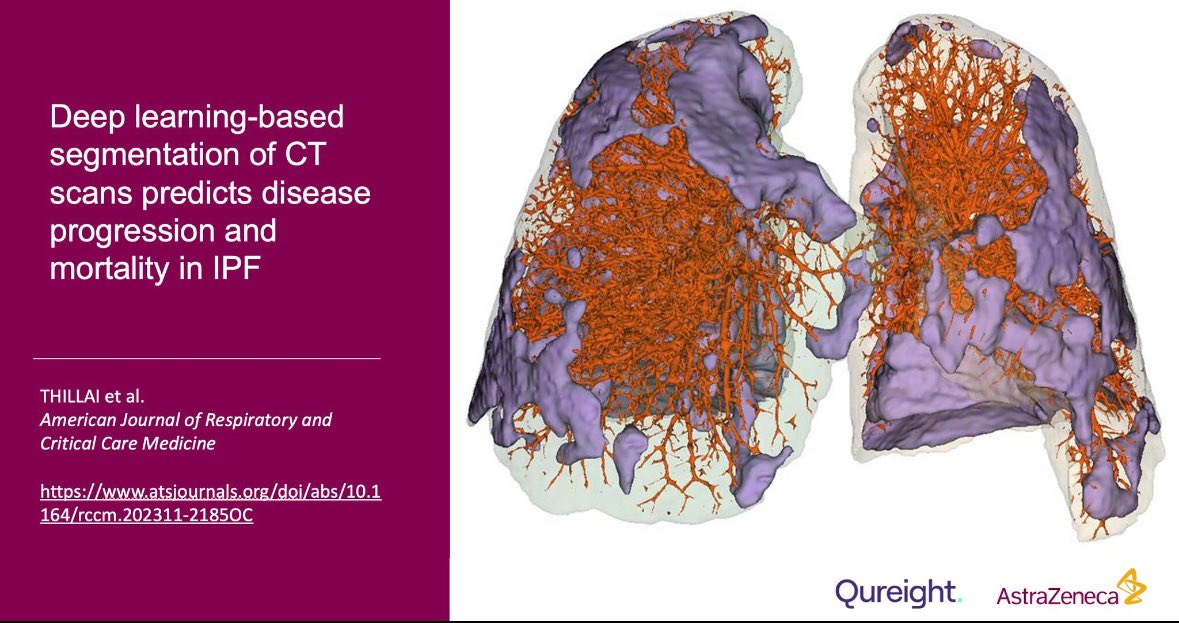 Predicting progressive disease and mortality in IPF using automated analysis of CT scans. A massive collaborative effort between @ImperialNHLI @qureight & @AstraZeneca now in press @ATSBlueEditor #cureipf atsjournals.org/doi/abs/10.116…