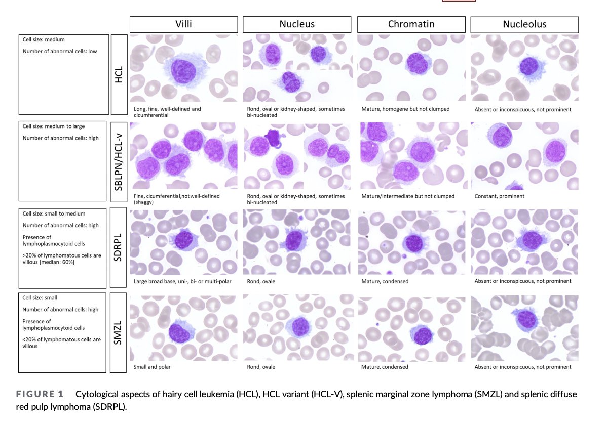 AjHematology's tweet photo. We propose an update on HCL diagnosis & differential diagnosis w/HCL variant form & SDRPL. We also update our therapeutic algorithm including BRAF, MEK, BTK, Bcl-2 inhibitors & anti-CD22 immunotoxins in R/R setting.
https://t.co/sRVV2ZxWIo https://t.co/CWOD3iTr3Y