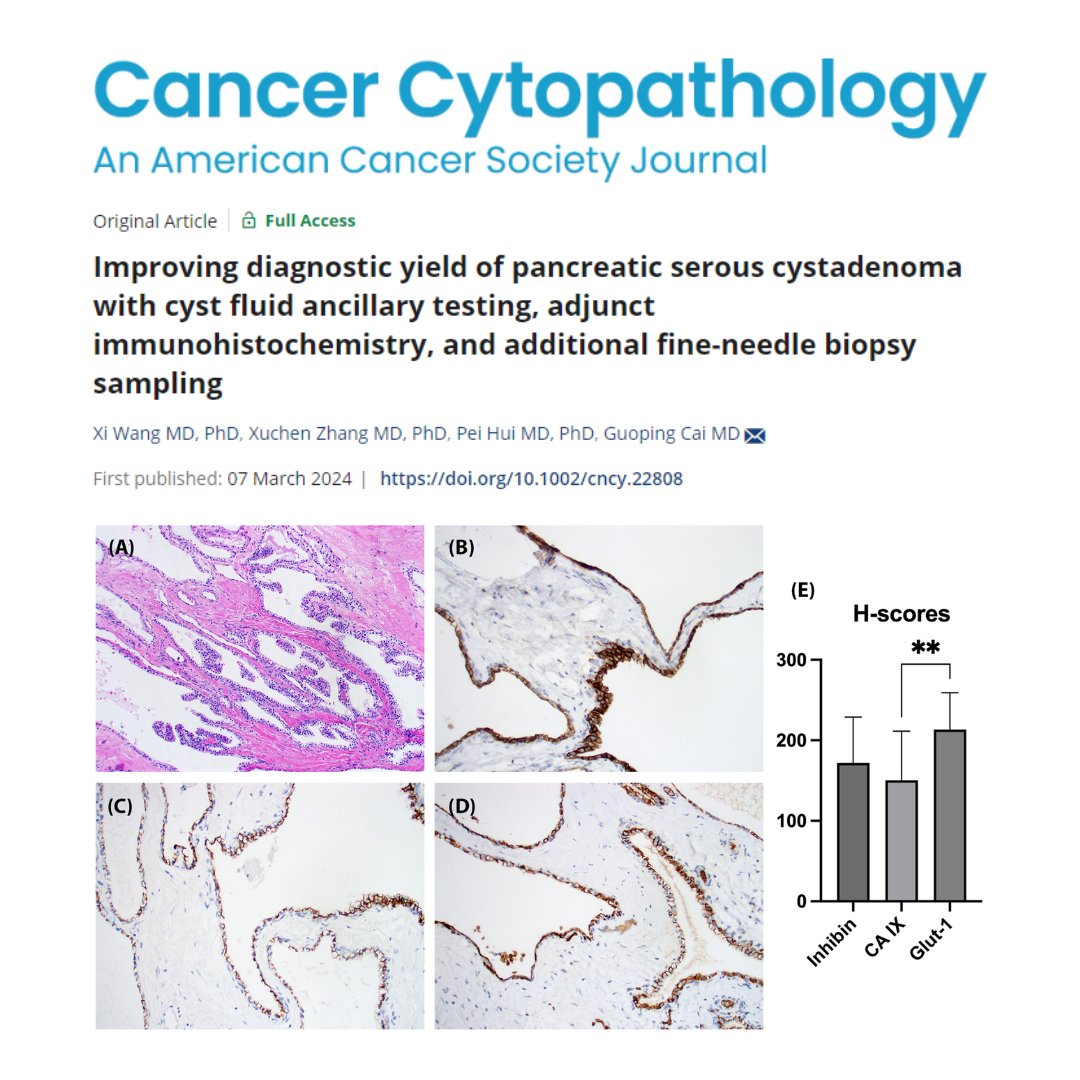 New from <a href="/gcai1978/">Guoping Cai, MD</a> et al | This study suggests that FNA diagnosis of SCA remains challenging even with ancillary testing including cyst fluid CEA level and KRAS mutation analysis. 

acsjournals.onlinelibrary.wiley.com/doi/full/10.10…

<a href="/zhang_xuchen/">Xuchen Zhang</a> <a href="/Hui2Pei/">Pei Hui</a> <a href="/XiWangPath/">Xi Wang, MD/PhD</a> #CytoPath
