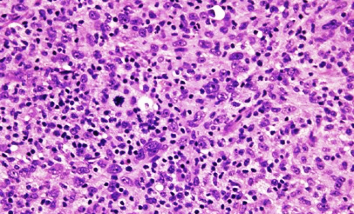 Markuseckstein3's tweet photo. 🎉🔬 The 16th episode is out. 

We are still in the middle of #subtype #urothelial #cancer histologies. 
👉 what is the prime example of an inflamed UC with high checkpoint expression 🤓? 🔥🔥🔥🔥

👉 How would you call the histology below on the picture below ? 

@AmerUrological, @Uroweb, @ASCO, @PathSoc. #Uropathology #urothelial #cancer #MedicalInnovation @NEJM @JAMANetwork @JAMA_current @OncoAlert @onkowissen @imedverse @Histo_Journal @niklas_kluemper #pathtwitter
@brookmans76 @PGrivasMDPhD @DrYukselUrun @shilpaonc @drenriquegrande

🚨🚨 Summary of all episodes 👉 https://t.co/SYeRhPrGcc