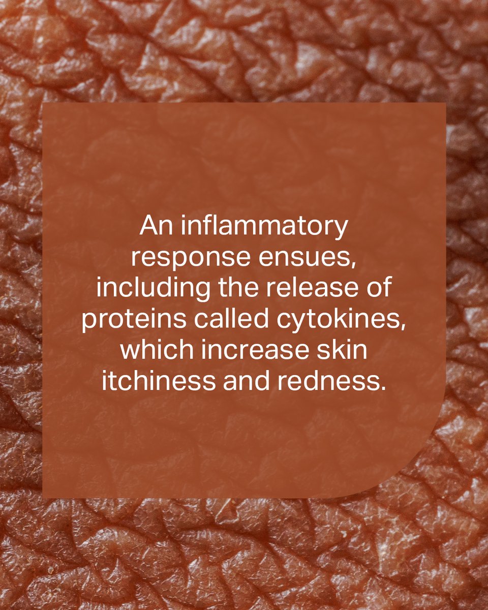 Curious to learn more? Read about #Inflammation and its role in Eczema: nationaleczema.org/blog/heres-wha…

#Eczema #AtopicDermatitis #GetEczemaWise #Inflammation #ImmuneSystem #ImmuneResponse