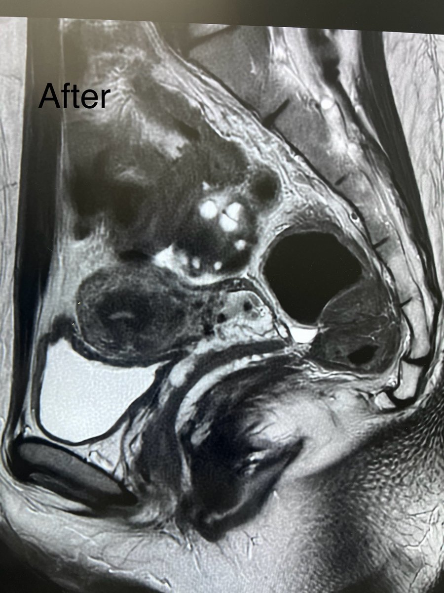 A 30-year-old female with chronic pelvic pain and pressure symptoms had an MRI revealing a large endometrioma. She treated with sclerotherapy
 A follow-up MRI after a few months showed absence of the endometrioma. The patient is now free of symptoms with a preserved ovary