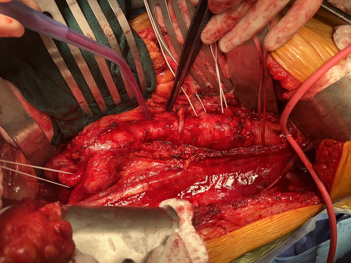 @PipeCabreraV @BBASS_skills @rbarbosa91 @pferrada1 @David_ukan @XavierBerardMD @VasculonR @docpark @AWBeckMD Tough angles made tougher in exposure . See how to set up the retractor , albeit retractor set ups are like armpits (or other A-words) that everyone has one .