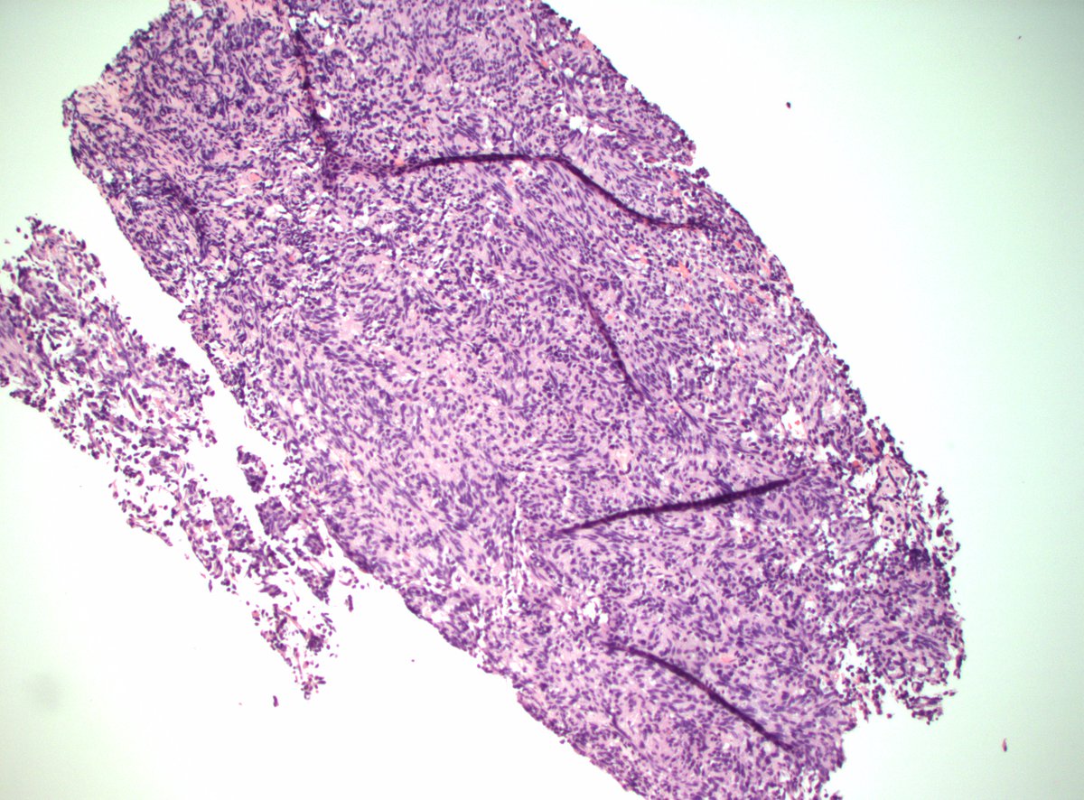 60s F multiple small bilateral lung nodules. Dx, ddx, stains?

#ThoracicPath #PathX #PathTwitter