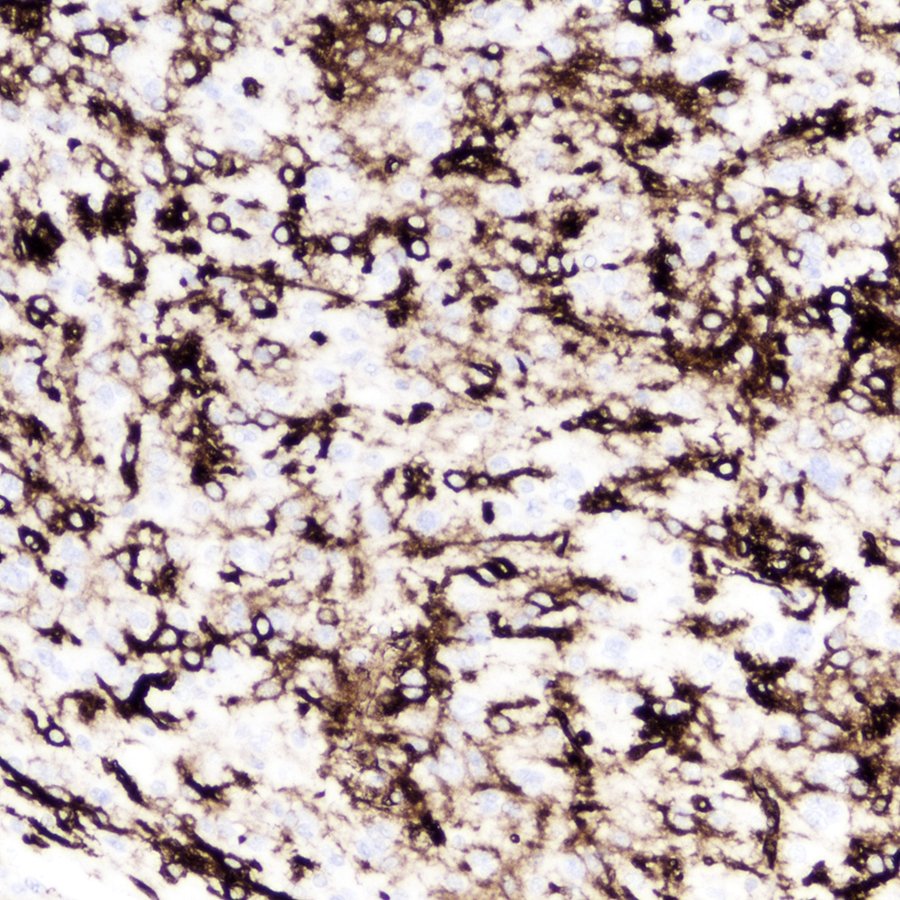 Superficial well-circumscribed temporal lobe mass in a young woman. NGS showed a BRAF V600E mutation. Diagnosis? (The CD34 immunostain at the end is PLeNTY good enough.) #pathology #neuropath #PathTwitter