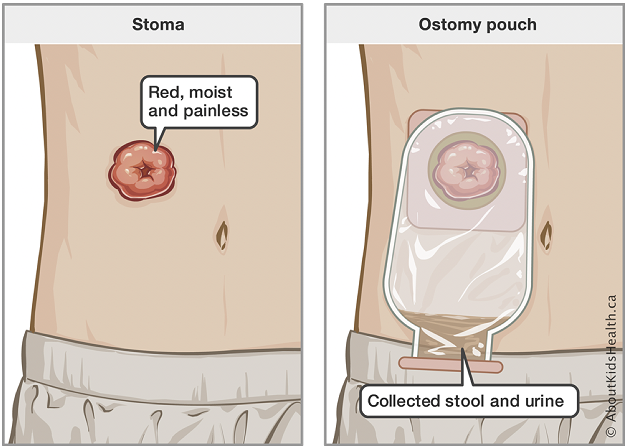 SKConnectedCare's tweet photo. Caring for a child with an ostomy? Check out our Quick Hit on stoma assessments! https://t.co/hxAPrmnbG1 https://t.co/982o3xiiES