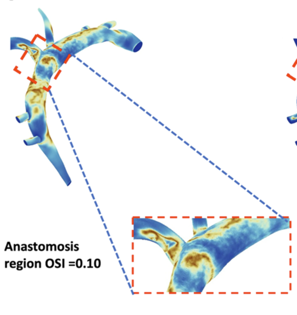 RandlesLab's tweet photo. Personalized flow models can be used to study how different treatments for pediatric #Cardiology patients influence resulting blood flow. Check out our latest work in CVET to learn more.
#PediatricCardiology #HLHS #3DCFDModels #CFD #DukeBME
https://t.co/NQ2IlUINOl https://t.co/XUsWsQjmyf