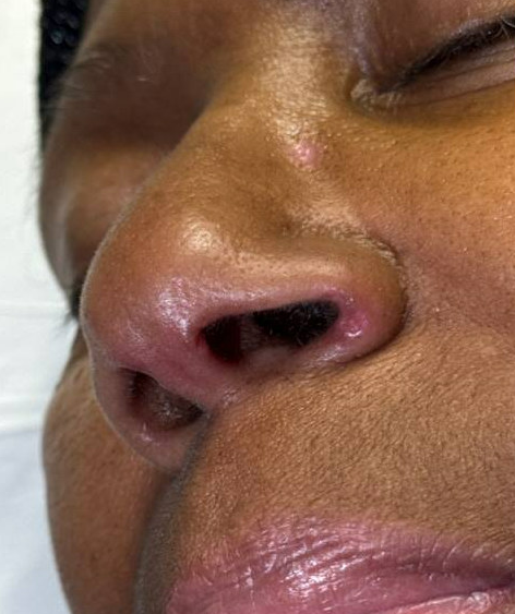 Nasal Rim Sign: A clinical manifestation of dermatomyositis

A 69 y/o African American woman presented with 3-month history of digital ulcers, Raynaud’s phenomenon, and occasional cough, in addition to eruption on nose, back and elbows

In A&amp;R
loom.ly/xx-r-vs
<a href="/Dr_SubCute/">Sweta Subhadarshani, MD, MRCP(SCE)</a>