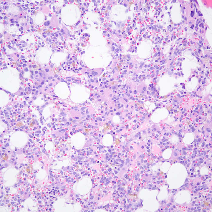 mingfei_yan's tweet photo. AML with MECOM (EVI1) translocation. Commonly associated with pronounced megakaryocytic dysplasia and hyperplasia. Some patients can present with thrombocytosis. The prognosis is poor. https://t.co/ewWEEC6Eka