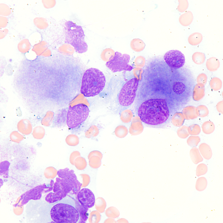 AML with MECOM (EVI1) translocation. Commonly associated with pronounced megakaryocytic dysplasia and hyperplasia. Some patients can present with thrombocytosis. The prognosis is poor.
