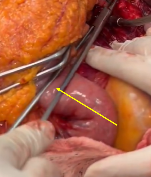 rbarbosa91's tweet photo. @PipeCabreraV @BBASS_skills @pferrada1 @David_ukan @XavierBerardMD @VasculonR @docpark @AWBeckMD Unrelated, but the video shows something I like to point out:  it's possible to injure the bowel with the proximal portion of the needle driver.  This can occur because the person sewing is usually looking elsewhere.  In fact, there's a scuff mark on the bowel from this. https://t.co/V7Okmmq9w1