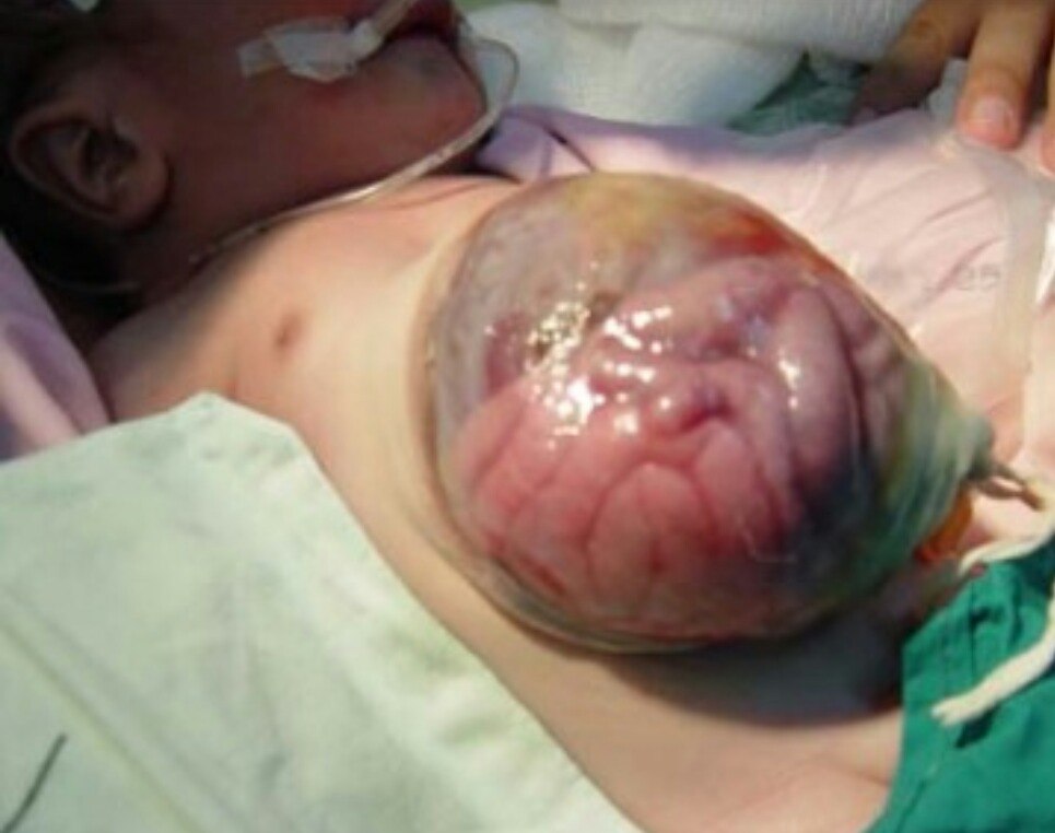 This is An Omphalocele,,,