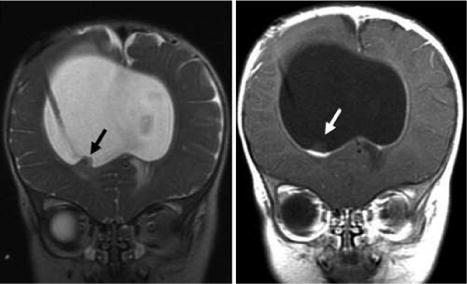 You've seen paranasal sinus fungal balls. But have you seen an intraventricular fungal ball? Look for a nonenhancing tuft sitting on a base of thick enhancement on the ventricular wall. Risk factors for CNS candidiasis: premature neonates, shunt/devices doi.org/10.3171/2009.7…