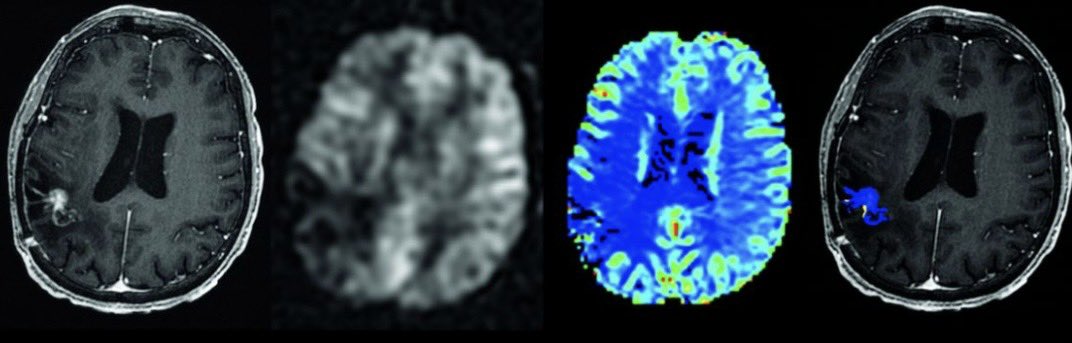 For those who interpret postTx #glioma #GBM MRIs:

Perfusion is helpful for accurate interpretation, but which metric (ASL-CBF, DSC-rCBV, DSC-FTB) yields highest agreement and confidence in interpretation?

Check out our recently pub study in <a href="/TheAJNR/">AJNR</a>: tinyurl.com/446yb3ee