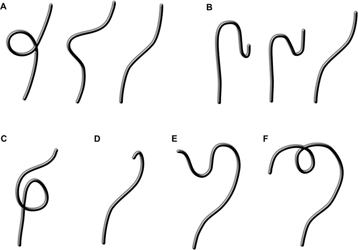 🧠 A quick Saturday quiz. Do your recognise all these l➿ps in colonoscopy? Answers in the next post👇 #MedTwitter #GITwitter #Colonoscopy #Endoscopy Article credit: fg.bmj.com/content/11/6/4…