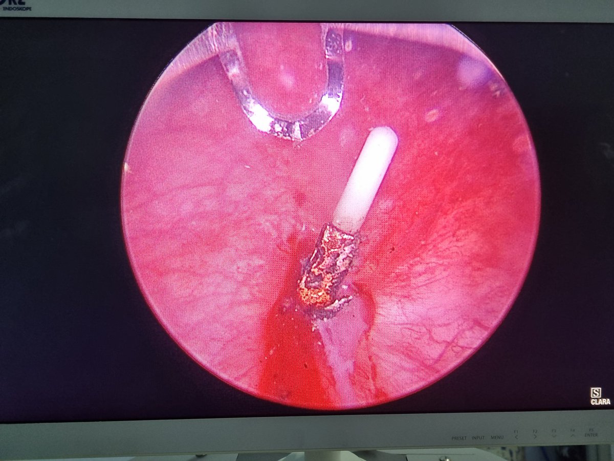akhadam77's tweet photo. Bismillaah
Berbagi kasus terutama pada adik2 urolog muda dan dr umum. Jadi ada seorang wanita umur 30-an tahun dtg dengan keluhan kalau kencing merasa tdk nyaman dan kadang nyeri sejak 1 tahun. Kencing lancar namun tertahan d akhir. Pasien sering k dokter dan diberi antibiotik namun tdk ada perubahan. Pasien juga ada riwayat pemakaian IUD sudah 6 tahun. 
Dari hasil usg urologi normal, tdk ada batu. Akhirnya sy putuskan utk dilakukan sistoskopi. Dugaan sy sebelumnya adalah penyempitan leher kandung kemih (bladder neck contracture) atau ada penebalan mukosa muara uretra yang menutup uretranya.
Ternyata saat dilakukan sistoskopi yg ditemukan diluar dugaan, yaitu si IUD yg harusnya d uterus pindah k kandung kemih. Akhirnya corpal tsb kami evakuasi dgn stone punch. 
Take home lesson :
1. Kalau ada pasien dgn keluhan infeksi kandung kemih yg lama dan sering kambuh padahal sudah diberi antibiotik, apalagi ada keluhan dgn kelancaran kencing, maka sebaiknya dilakukan sistoskopi. Biar bs diketahui dgn pasti penyebabnya.
2. Ternyata IUD ini expired nya 5 tahun kata perawat2. Ini dah 6 thn. Kalau ketemu pasien dgn pemakaian iud lama maka sebaiknya dikonsulkan kembali k ts obgyn. Utk ini sy juga mohon pendapat TS Obgyn.
Semoga bermanfaat...