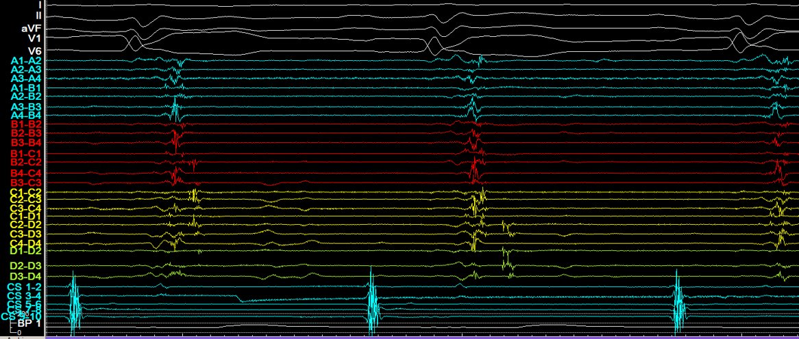 MEfraimidis's tweet photo. DCM Electrical storm-Epicardial approach-SR ILAM mapping with a small area of DZ. @SteliosDragasis .@ipetemil @Kariki_O @athsaplaouras @K_Letsas @BellosPeriklis  # Onassis Cardiac Surgery Center https://t.co/qhX0TvDNEZ