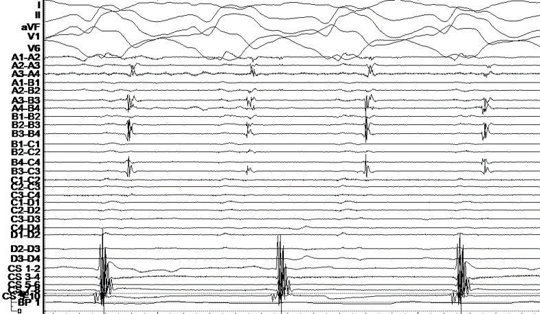 MEfraimidis's tweet photo. DCM Electrical storm-Epicardial approach-SR ILAM mapping with a small area of DZ. @SteliosDragasis .@ipetemil @Kariki_O @athsaplaouras @K_Letsas @BellosPeriklis  # Onassis Cardiac Surgery Center https://t.co/qhX0TvDNEZ