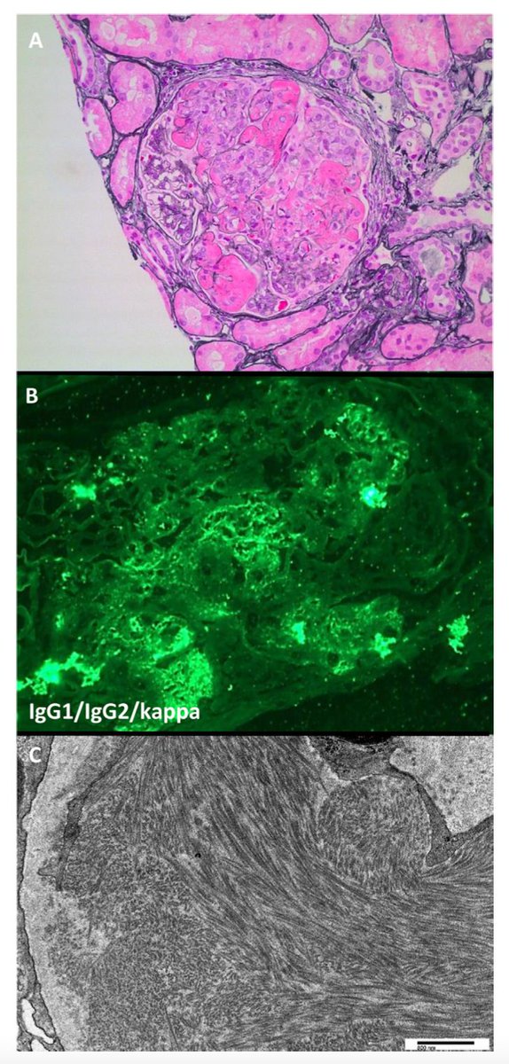 A middle-aged man presented with bilateral lower extremity rash, symmetric paresthesias of lower extremities, and small-volume hemoptysis. He received prednisone and rituximab. One year later, he developed hypertension and AKI. Differential diagnosis? 

buff.ly/3Ipyd7O