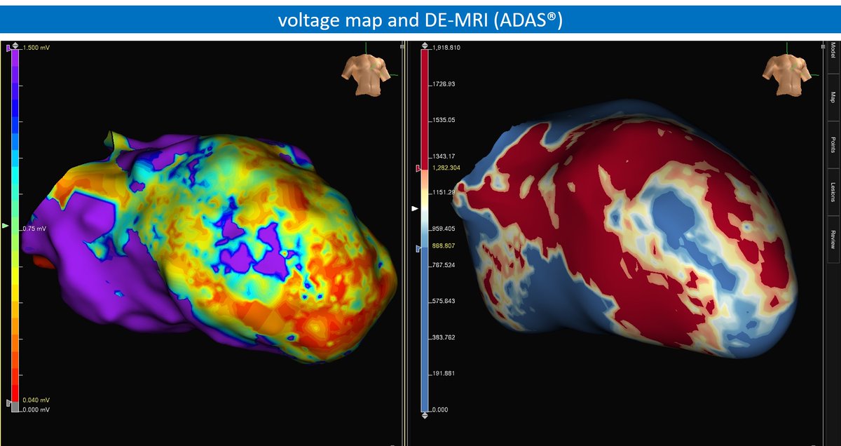 Local EGMs in VT showing the "missing" part of the diastolic interval. Baseline voltage map (1.5-0.04mV) and DE-MRI reconstruction showing a big LV anteroseptal scar.
