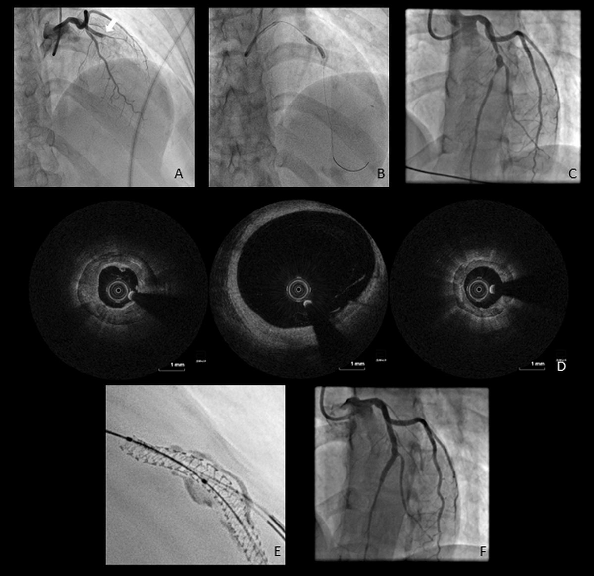 Editors' Insights: Spontaneous closure of iatrogenic epicardial coronary #pseudoaneurysm with #fistula to RV following post-stenting #perforation. tiny.pl/dmn4k #PolishHeartJournal #CardioTwitter #HeartNews #Cardiology #CardioEd @Marta33717088 @M_Lesiak @PUMS_tweets