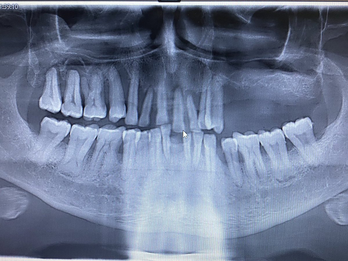 Taurodontism تعتبر من الحالات القليلة الحصول ، وجتني قبل اسبوعين حاله زيها تمام كانت تبغى تسوي زرعات لكن تفاجأت بوجود Taurodontism في الضروس الاخيرة السفليه و كذلك اختلاف تركيب الضروس الاخيرة العلوية (طبعاً المريضه عندها severe generalized periodontitis 

#mahri_game