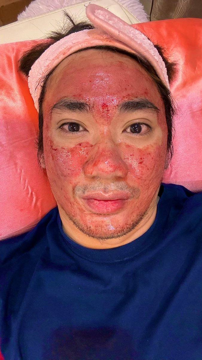 cholo0511's tweet photo. No Pain No Gain
#PRP #botox #subcision #exosomes #AlterCebu #alteriligan https://t.co/jws0uNZhI4