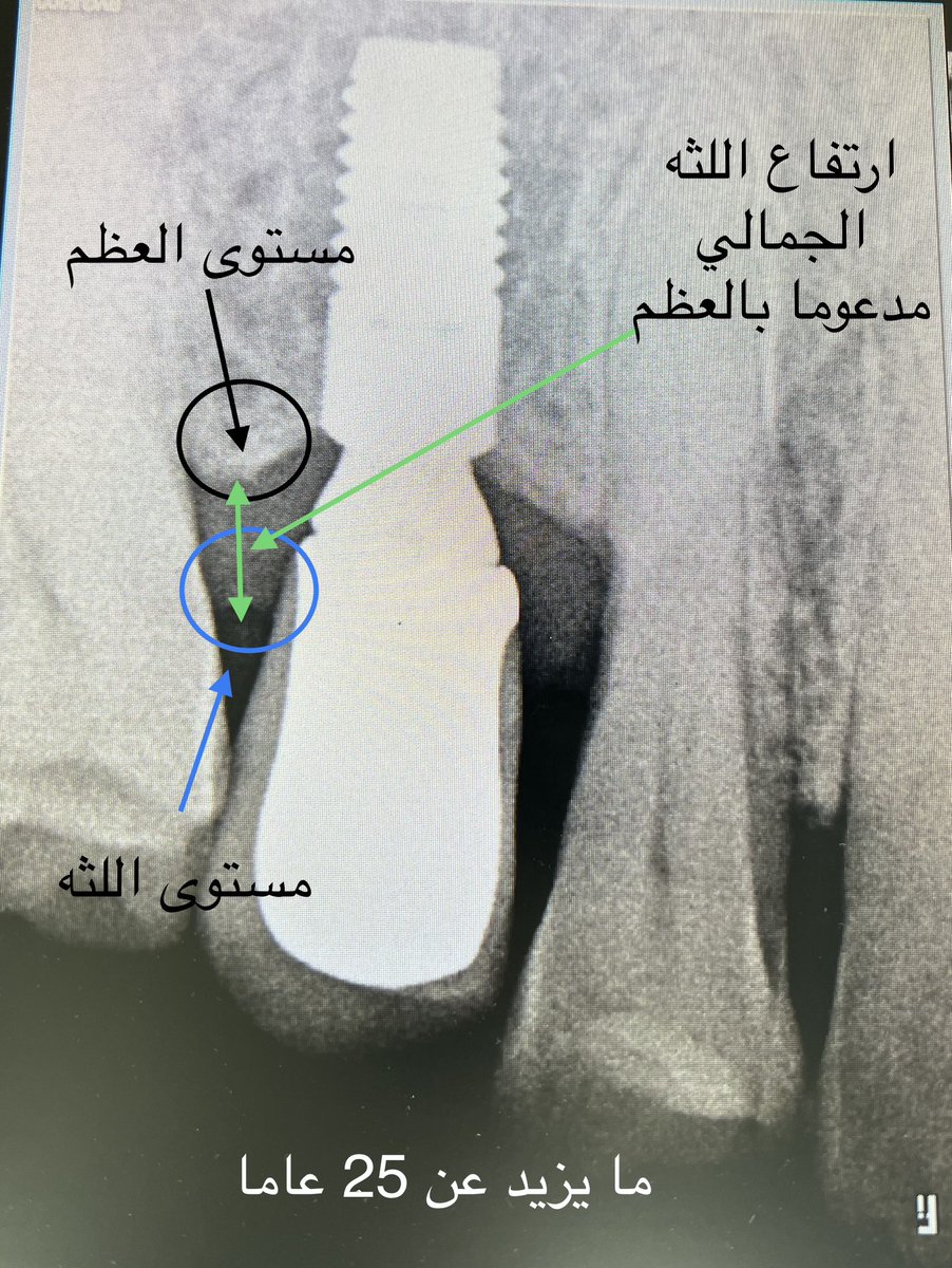 DrAlgufari's tweet photo. مراجع عرفني بنفسه وانه تم عمل  #زراعة_اسنان  له ما يزيد على 25 عاما …! تم اخذ اشعه لتوثيق الحاله 2024 و تم التاكد من الاشعة السابقه  الموجوده في ملفه 
2017, 2018, 2019 
هذه النتائج تحدث دائما عند تكامل منظومة نجاح الخطط العلاجية ومكوناتها المهنية . https://t.co/p0QkMFnvKa