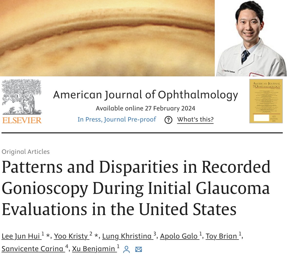 BenXuLab's tweet photo. Gonioscopy, a key part of the glaucoma evaluation, helps differentiate between open angle and #angleclosure #glaucoma. Our new study found only 30% of 200,000 Americans undergoing first-time evaluation had record of gonioscopy despite @aao_ophth recommendations. @AJOphthalmology https://t.co/YtIQc7tHCJ