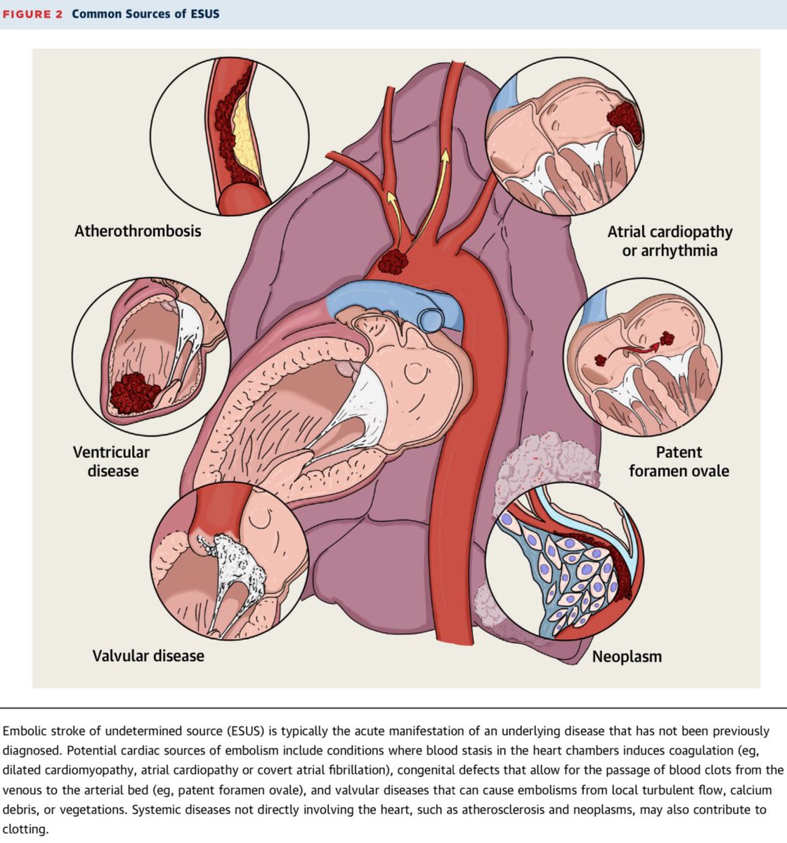 AmbrizMau's tweet photo. Terapia antitrombótica para la prevención primaria y secundaria de la enfermedad vascular cerebral isquémica.

J Am Coll Cardiol 2023; DOI: https://t.co/3eFK3UB9JD https://t.co/KMmvnnDvUI