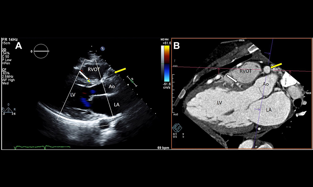 American Society of Echocardiography (@ase360) on Twitter photo We present a <a href="/CASEfromASE/">CV Case Journal</a> of anomalous right coronary artery from the pulmonary artery (ARCAPA) previously diagnosed in a young woman, which later represented a delivery planning challenge during a later pregnancy. bit.ly/3TtSyPC
#CASESpecialIssue #10DaysofCASE #ACHD We present a <a href="/CASEfromASE/">CV Case Journal</a> of anomalous right coronary artery from the pulmonary artery (ARCAPA) previously diagnosed in a young woman, which later represented a delivery planning challenge during a later pregnancy. bit.ly/3TtSyPC
#CASESpecialIssue #10DaysofCASE #ACHD