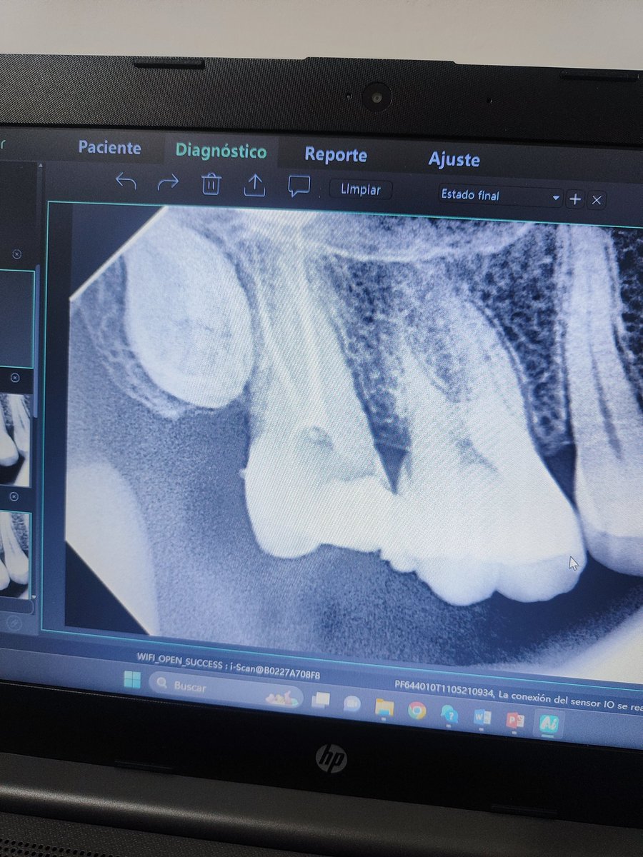 Segundo molar superior derecho en infra oclusión y microdoncia
Dx pulpar: Pia
