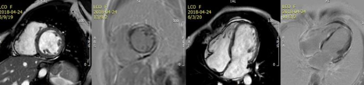 In 2011 we evaluated a 35 year-old 👩‍🦰 with palpitations and dyspnea after her first pregnancy. Soon after having a girl she was found to have a LVEF of 44%. Also she had frequent VE and intense fibrosis on CMR.