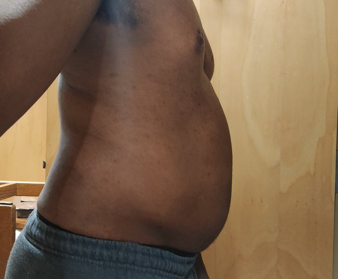 More n2o still messing with injecting from different spots. Didn't swell up around my belly button much