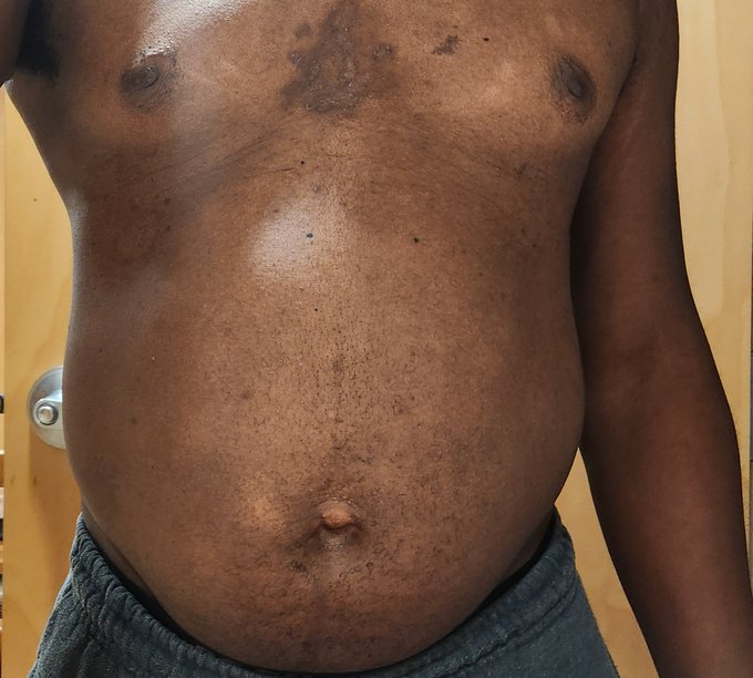 More n2o still messing with injecting from different spots. Didn't swell up around my belly button much