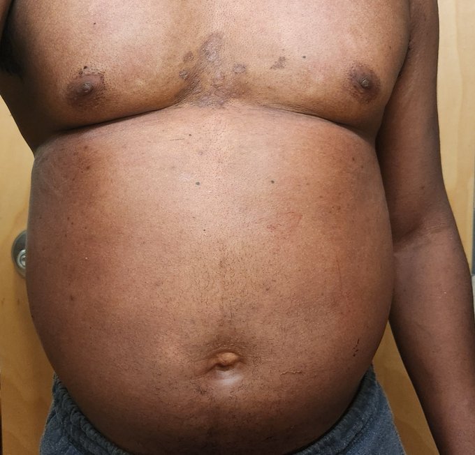 More n2o still messing with injecting from different spots. Didn't swell up around my belly button much