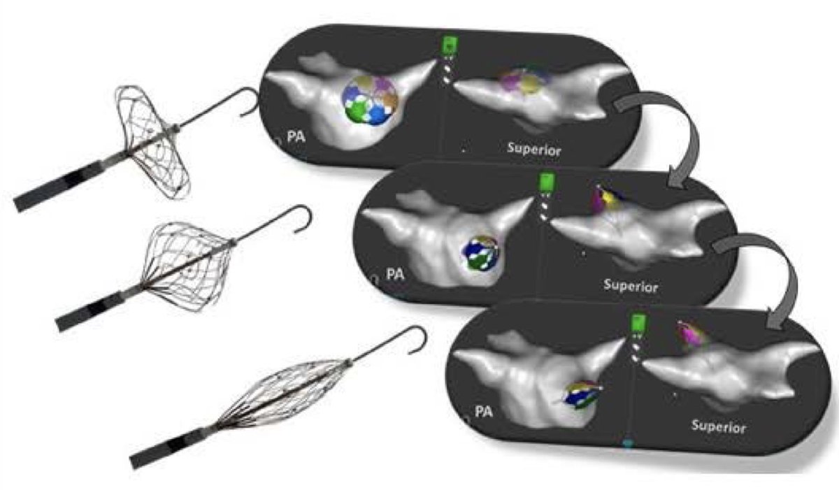 First human study of a groundbreaking PFA catheter (lattice, expandable up to 324mm) will be presented at #EHRA2024! Learn about procedural performance, safety, PVI durability, and 1Y outcomes in a multicenter study by @VivekReddyMD in one of the LBCT sessions. @EHRAPresident