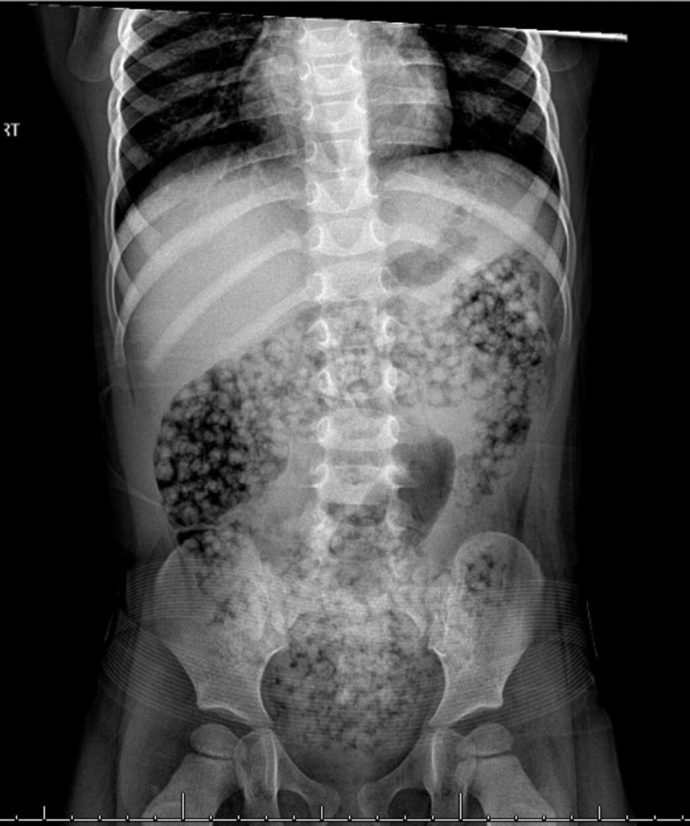 drkeithsiau's tweet image. Abdominal X-ray of a child presenting with abdominal pain and vomiting. What do you think has happened here?