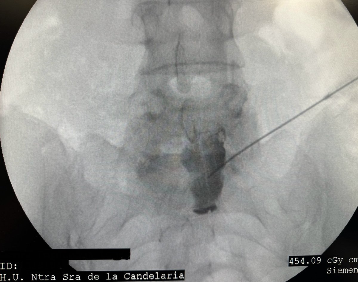 Bloqueo del plexo hipogastrico superior para tratamiento de dolor pélvico crónico. 
Abordaje transdiscal
#dolorcronico #pain