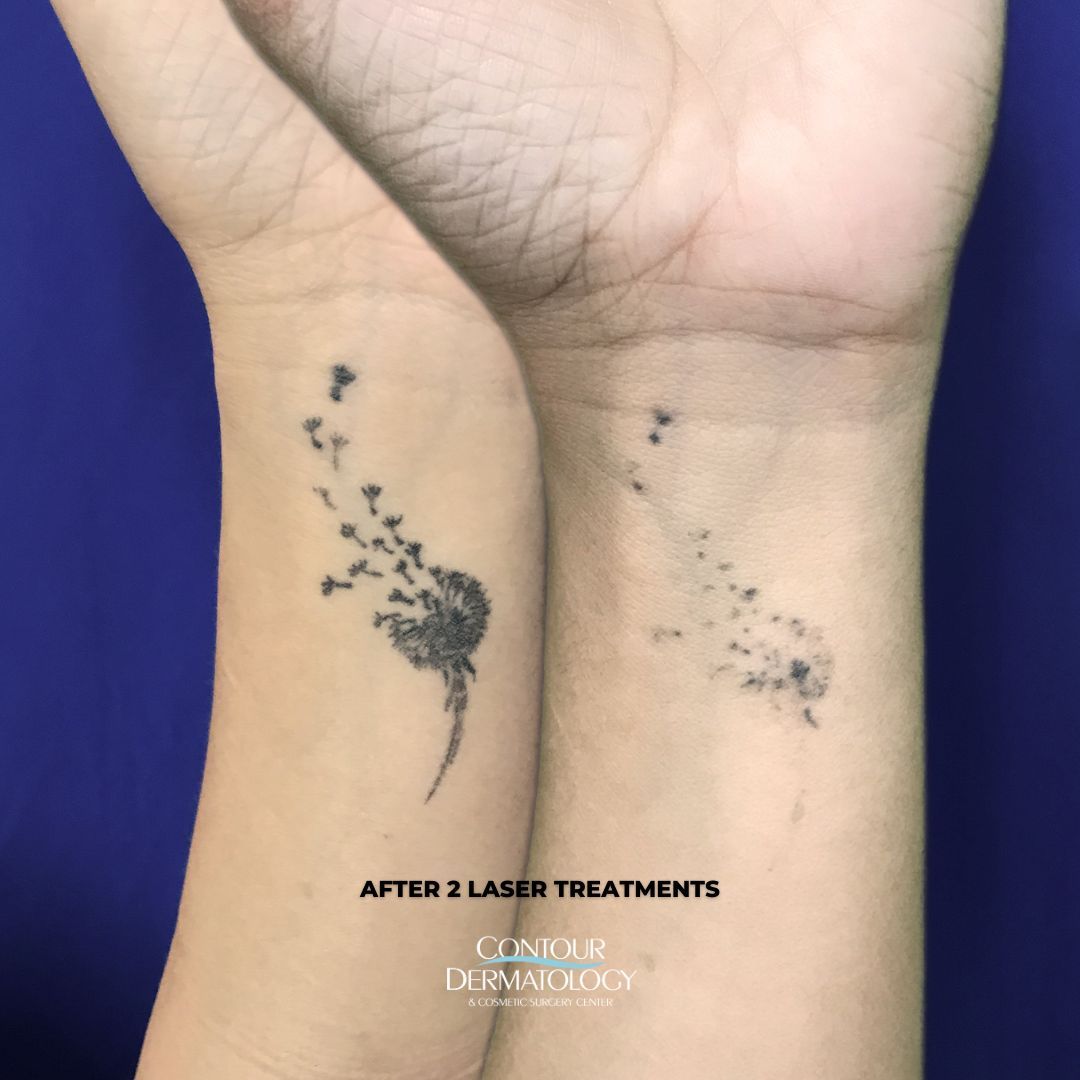 Guess which ink is the easiest to remove with a laser treatment? ⬇️ 

➡️ Black ink is the easiest color to remove with laser treatment because it absorbs all laser wavelengths. This makes it more effective for the laser to target and break down the ink particles.