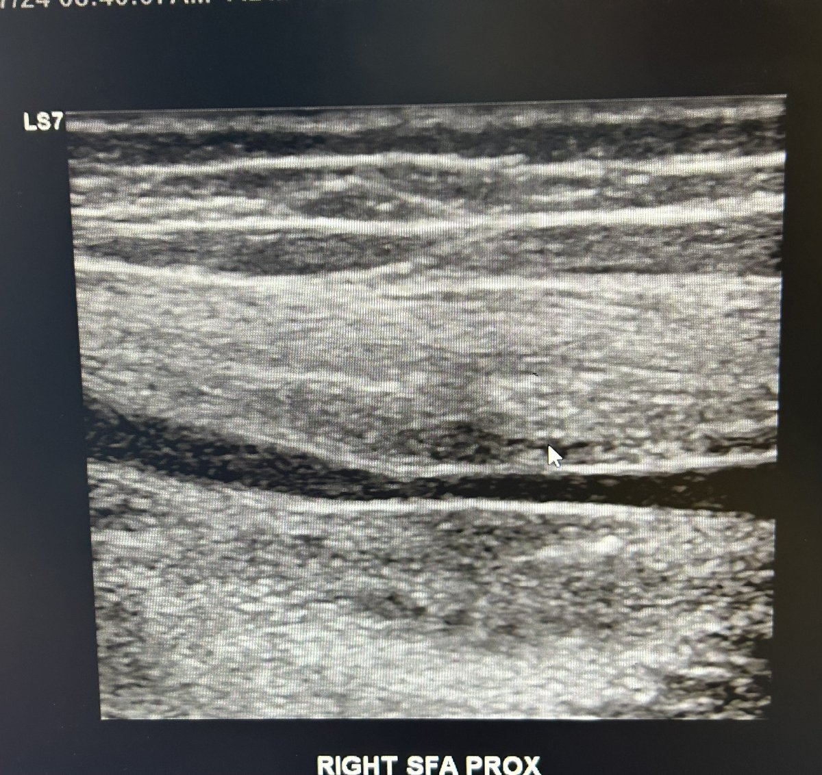 30 year old WF, active, mom of a 2 year old, woke up with sharp pain 1 yr ago, no trauma, now right calf claudication, and right upper thigh focal sharp pain with movement and touch. MRI – non-specific muscle changes. Rheum w/u negative. Duplex &gt;300 cm/s. Next step? Biopsy?