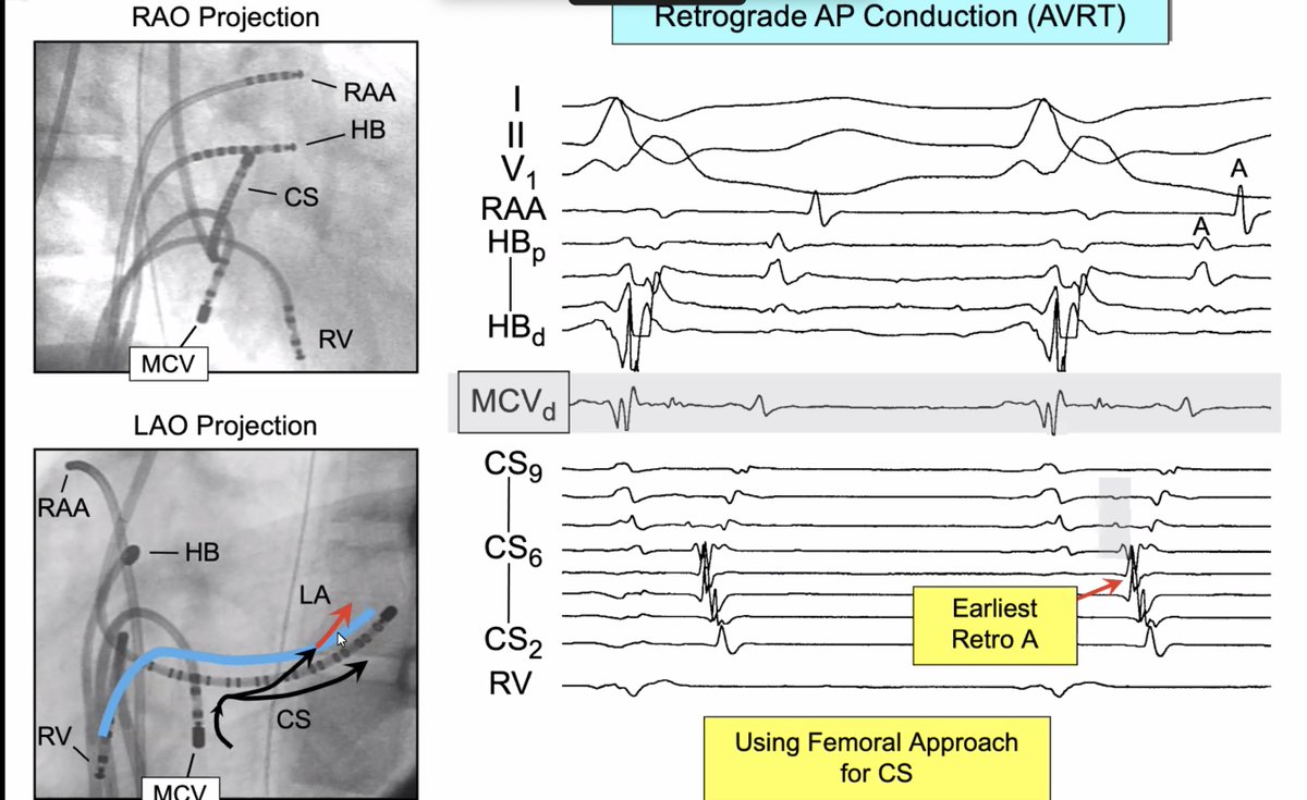 SanjoyKChy's tweet photo. "You don't realise what's going on because you're high" - Dr. Warren "Sonny" Jackman on importance of CS floor vs. roof signals (femoral vs. IJ access) for conventional vs. epicardial left posteroseptal APs.
#EPeeps #ablateAP https://t.co/NmkSCNgcJR