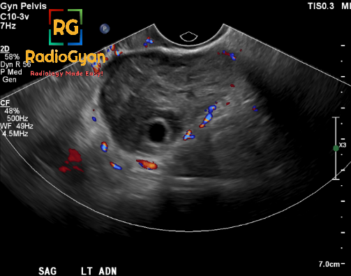 Hx: Severe pelvic pain. Diagnosis? Answer and Discussion : bit.ly/49KFN9a #RGcases #radiogyan #radiology #radres #radiologia #FOAMrad #FOAMed